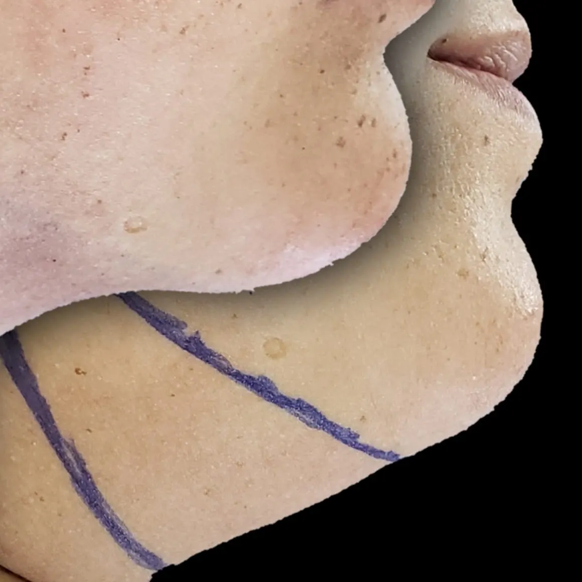 Sobreposição de duas fotos de perfil da região abaixo do queixo: antes da cirurgia, com marcações em caneta, e depois, com o contorno entre o queixo e o pescoço mais definido