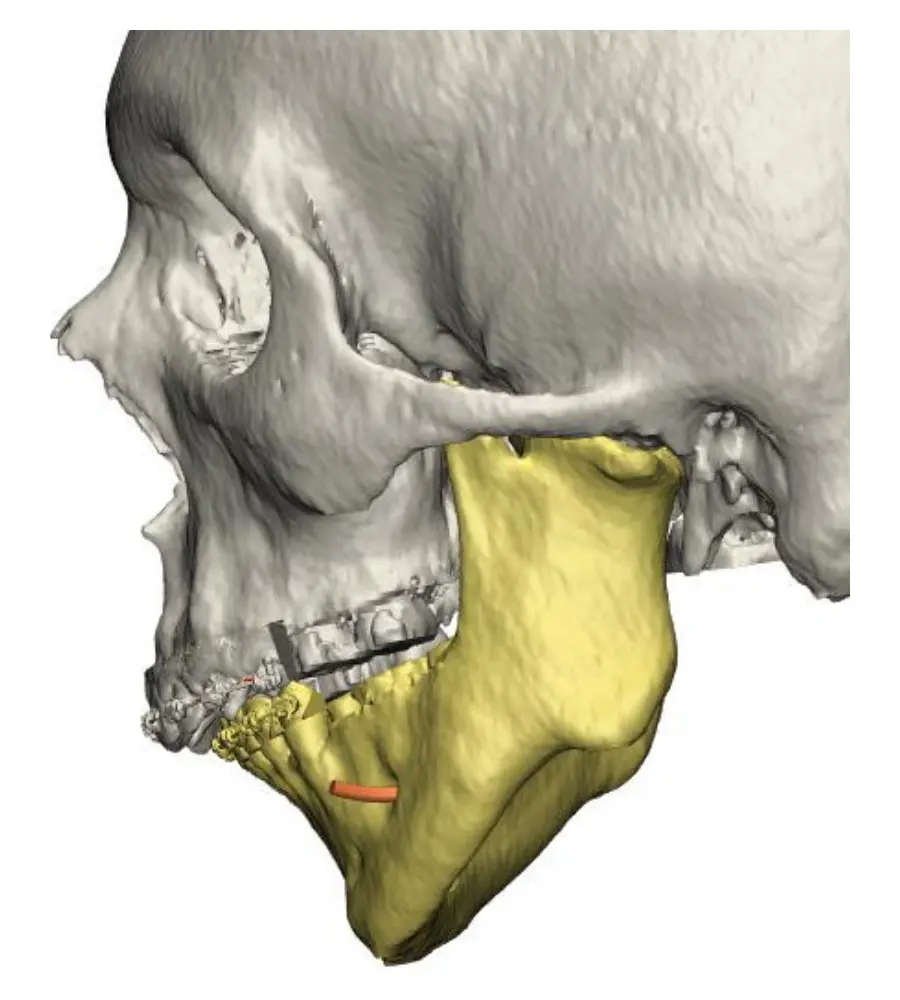 Reconstrução 3D da tomografia, vista lateral esquerda do crânio e da mandíbula antes da cirurgia