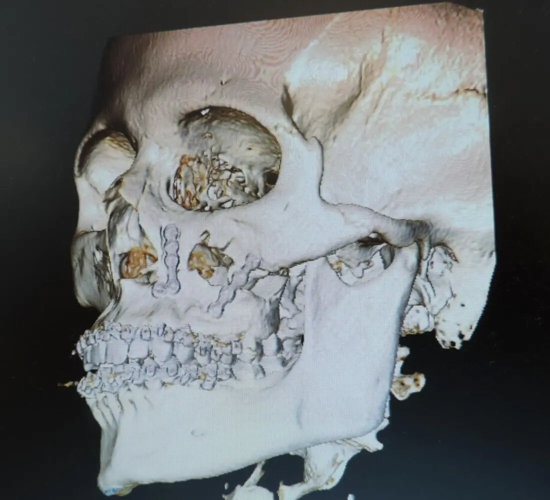 Reconstrução 3D de tomografia após a cirurgia, com placas e parafusos de titânio fixando fraturas da maxila