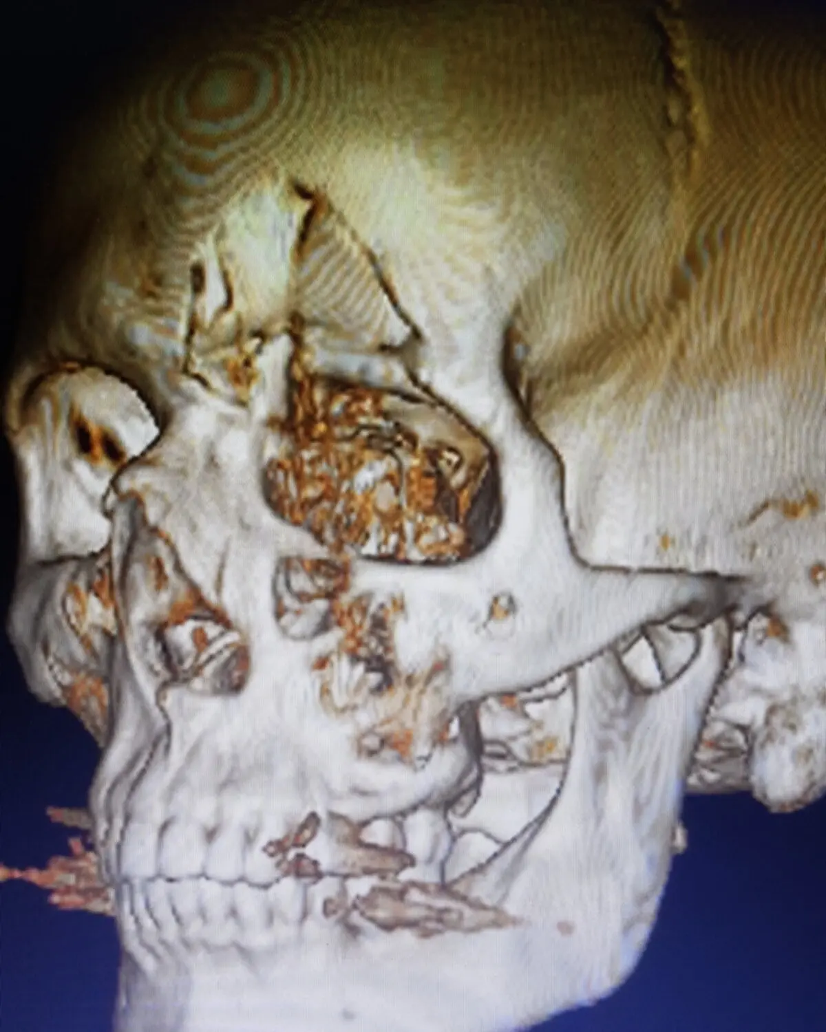 Reconstrução 3D de tomografia mostrando múltiplas fraturas dos ossos da face, ao redor da órbita, do nariz e da maxila